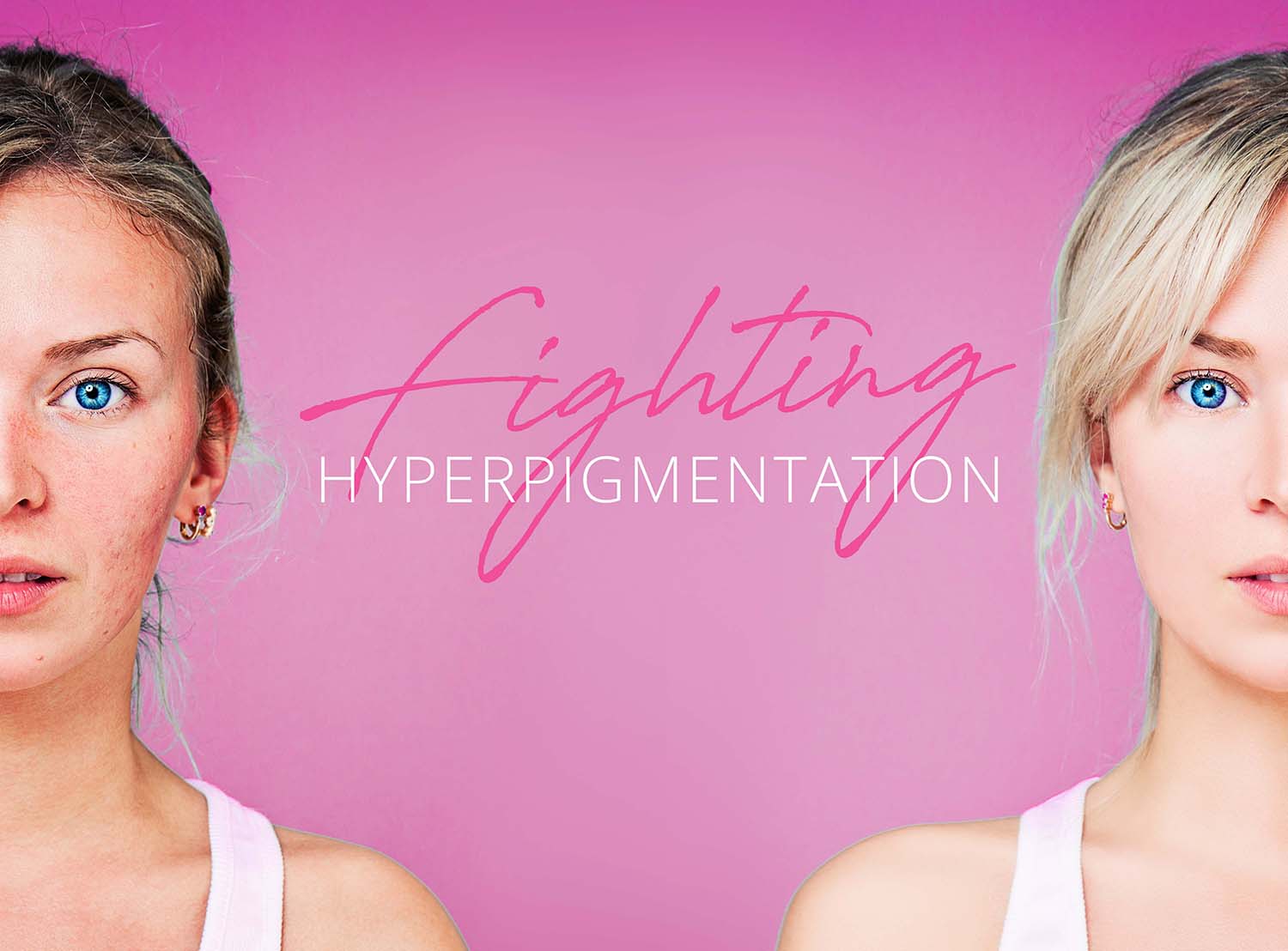 Young woman showing before and after hyperpigmentation
